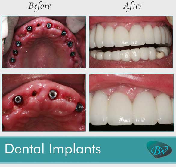 dental implants before and after