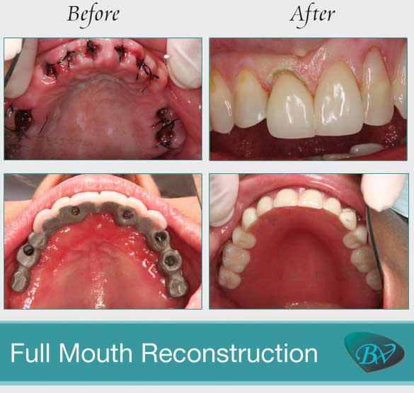 Full mouth reconstruction before and after