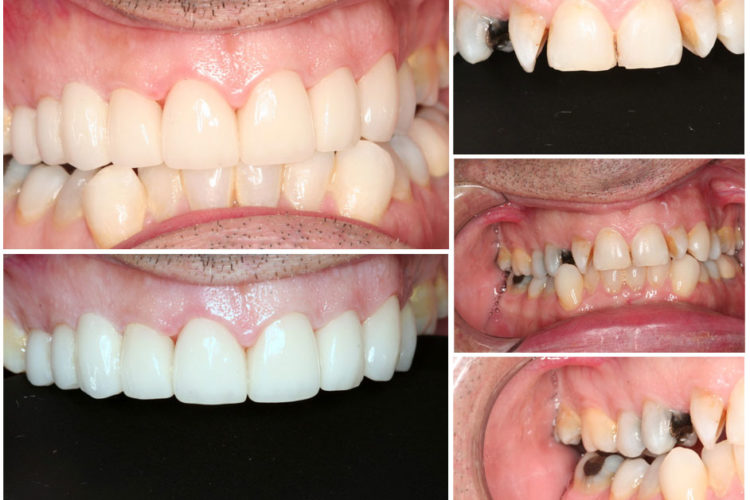 Full mouth reconstruction Los Angeles