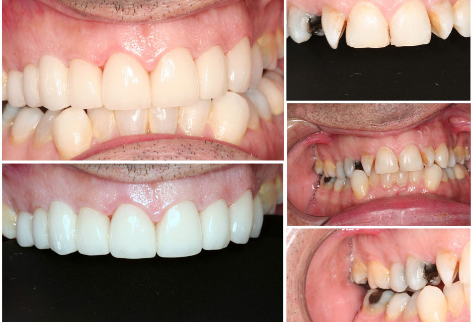 Full mouth reconstruction Los Angeles