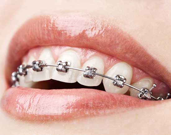 Types Of Braces, Braces Treatment In Beverly Hills