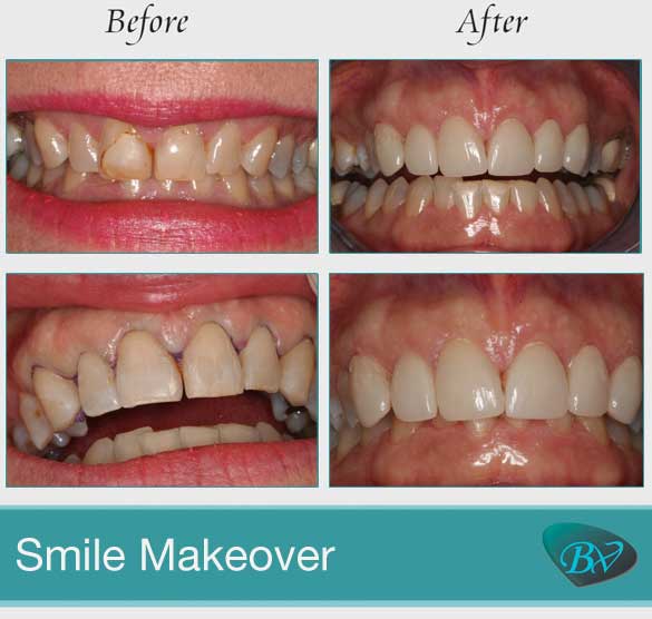 smile makeover Before and After