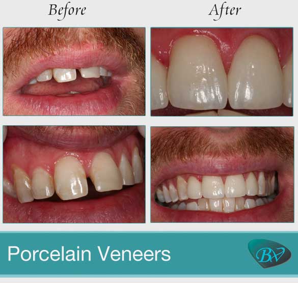 Porcelain Veneer Cost In Los Angeles, CA