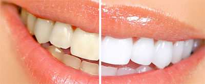 Teeth whitening Beverly Hills