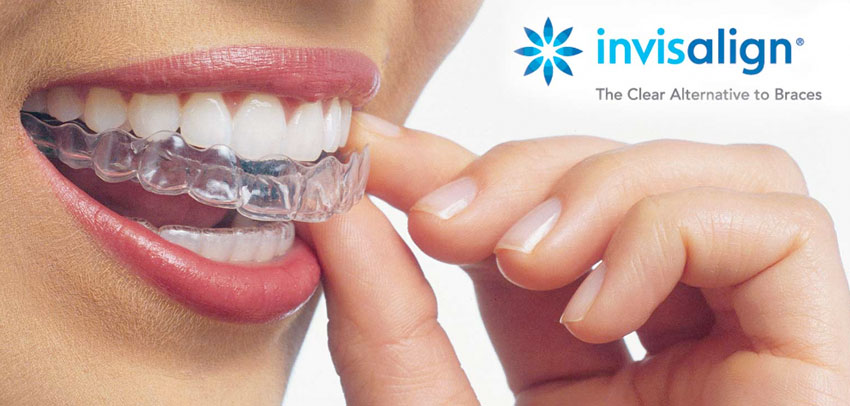 beverly hills best invisalign dentist
