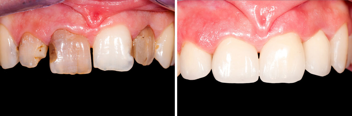 Fix Crooked Teeth With Veneers before and after