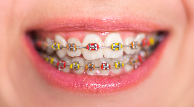 A Complete Guide to Different Color Braces and Ideas for