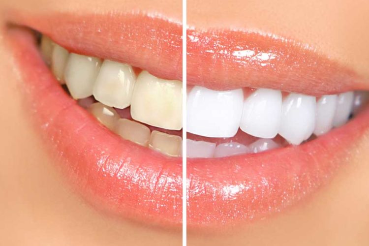Zoom Teeth Whitening Cost