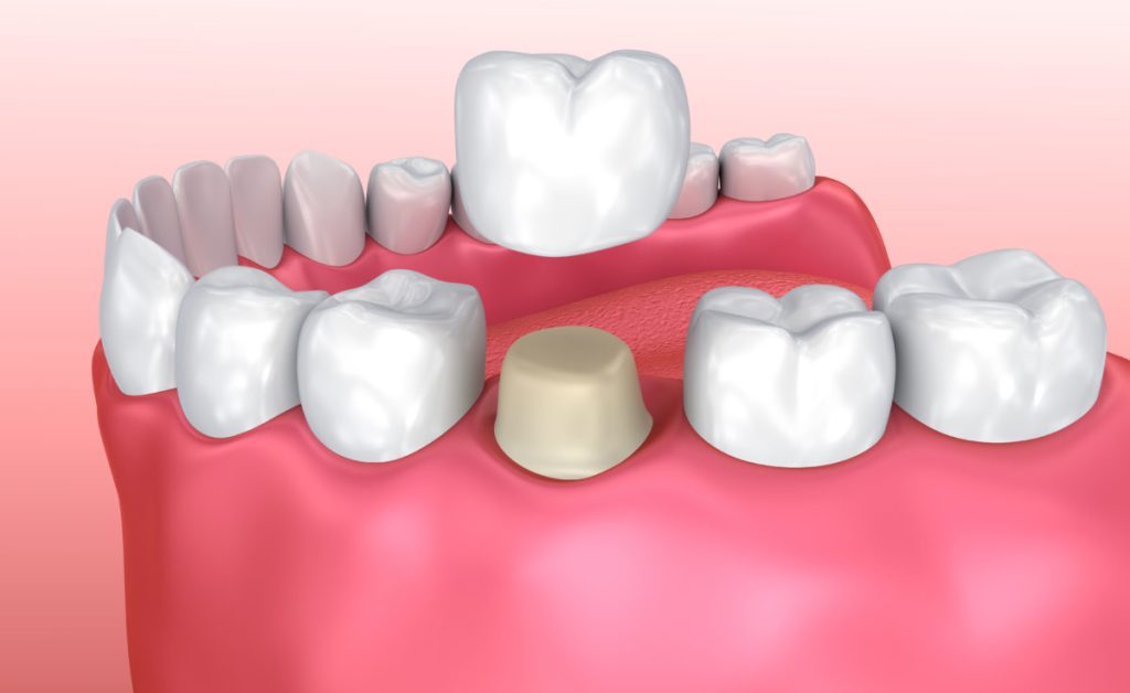 dental crown procedure