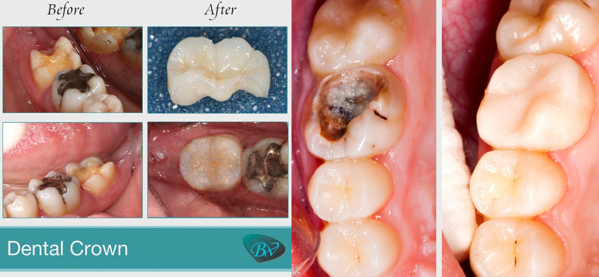 dental crown Los Angeles