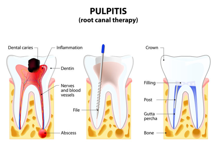root canal therapy Beverly Hills