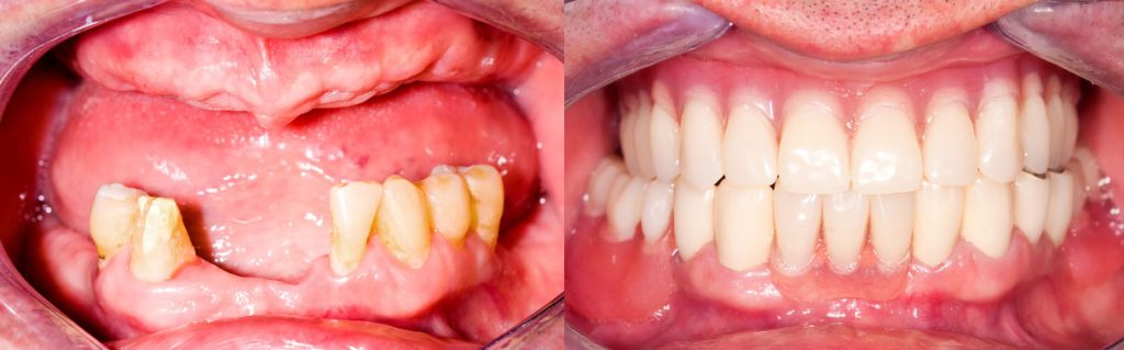 Dental implants before and after