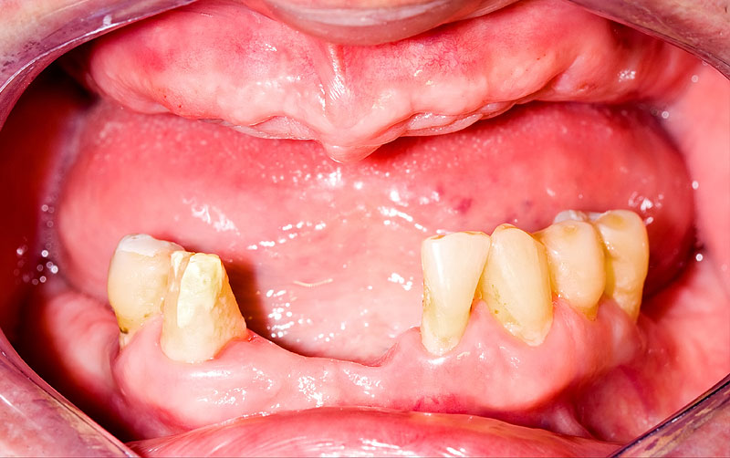 Dental Implants Archives | Smile Angels of Beverly Hills - Bruce Vafa DDS.