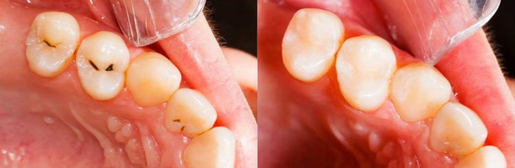 Did you Know Mercury Fillings Can Cause Poisoning - Smile Angels of
