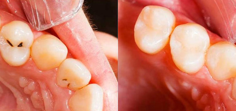 non toxic dental fillings