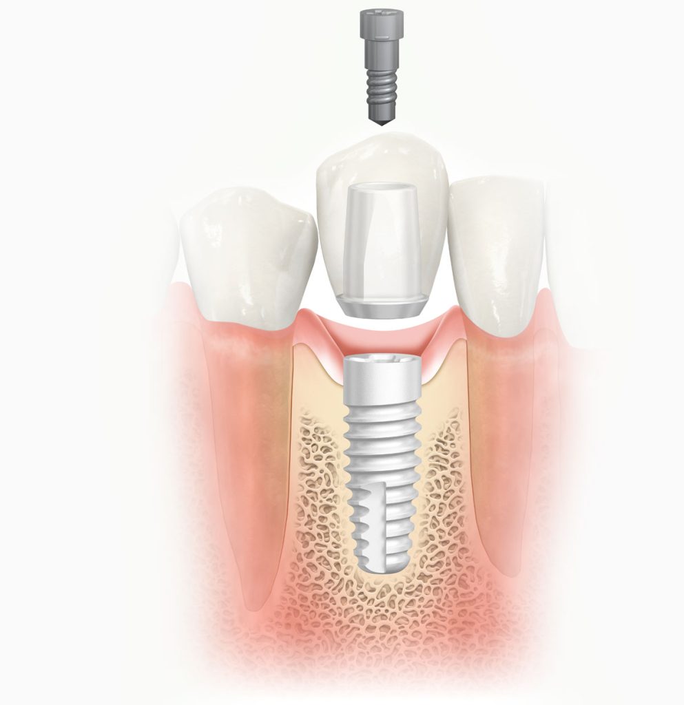 dental implants Beverly Hills