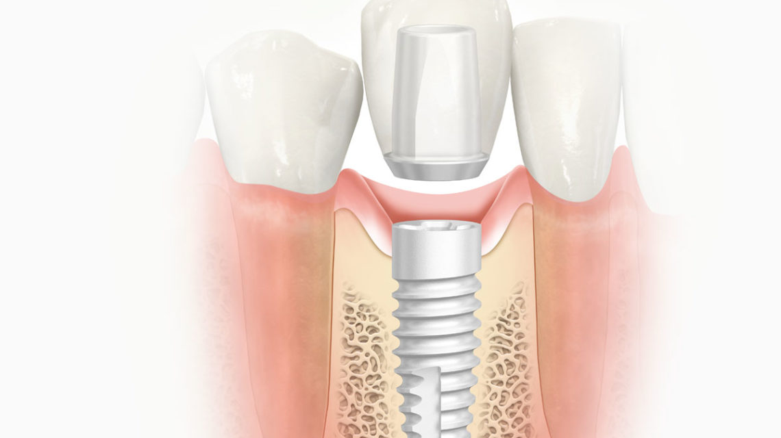 dental implants Beverly Hills