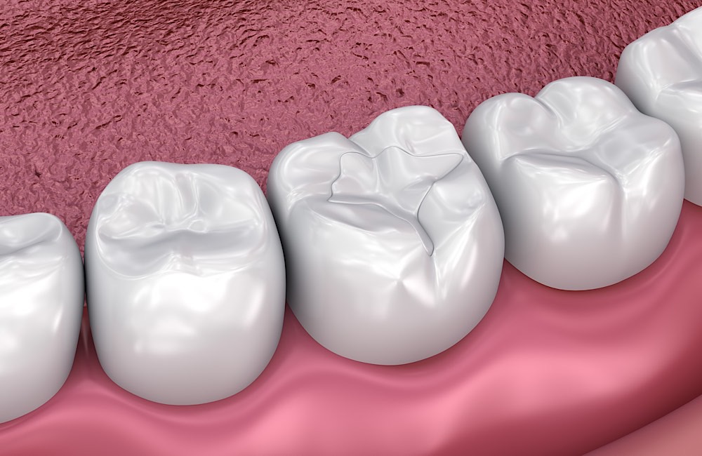 White dental fillings