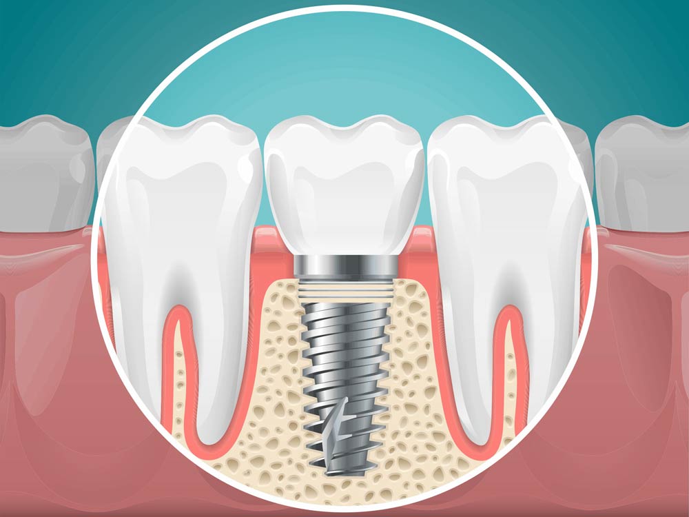 bone graft for dental implants los angeles