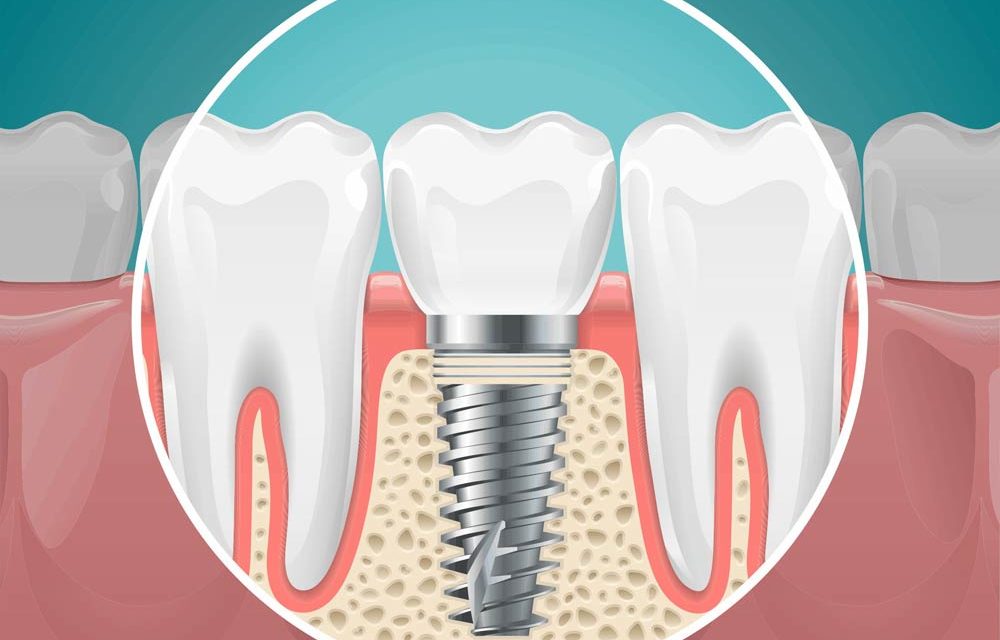 bone graft for dental implants los angeles