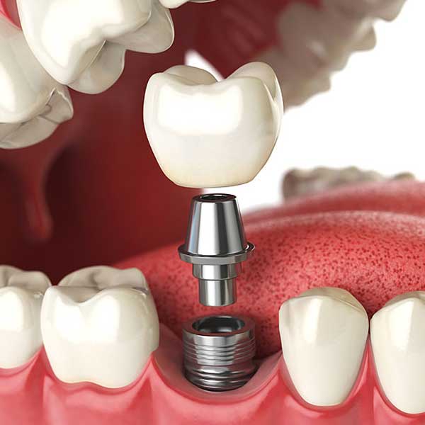 same day dental implants Los Angeles