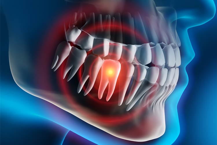 tooth extraction los angeles