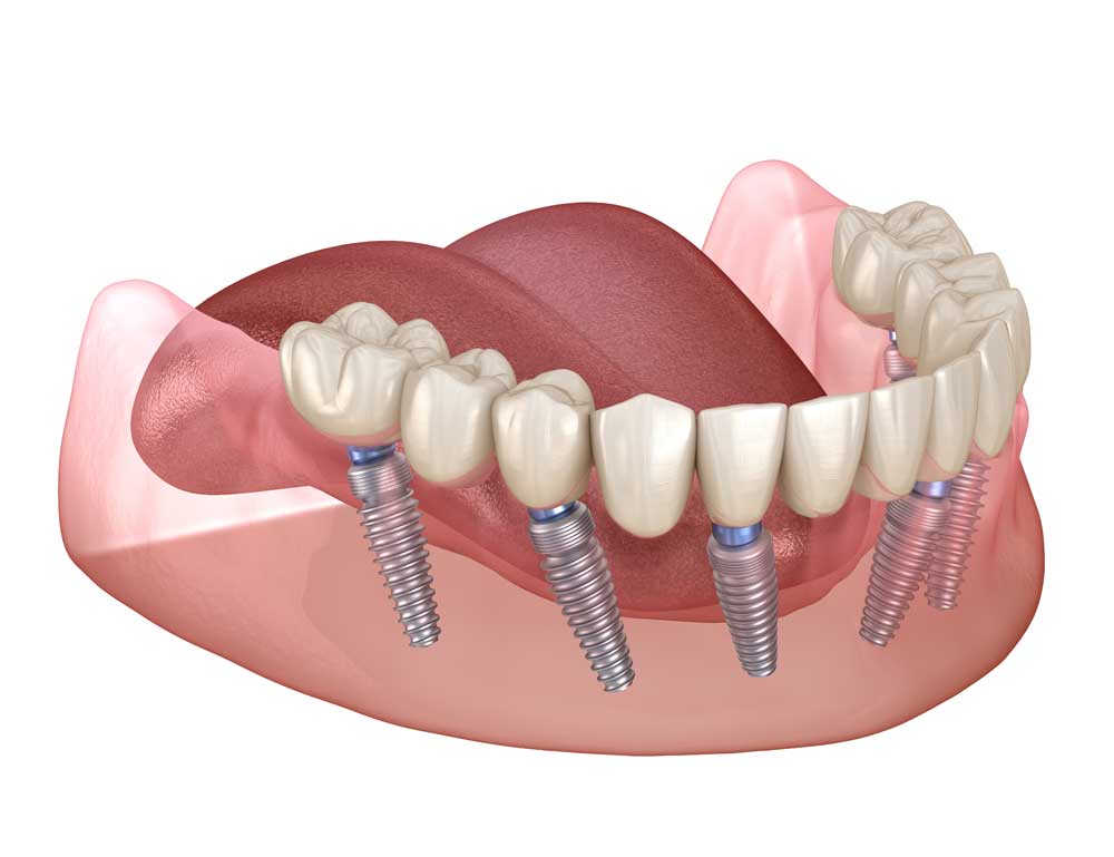 full mouth dental implants Beverly Hills