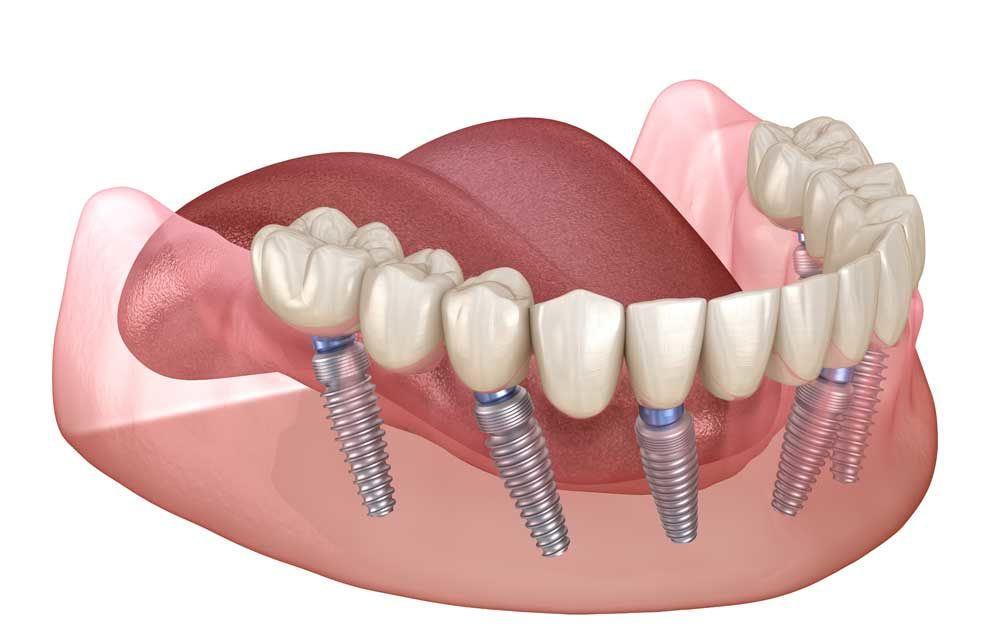 full mouth dental implants Beverly Hills