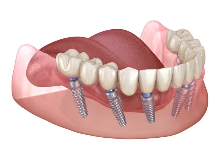 full mouth dental implants Beverly Hills