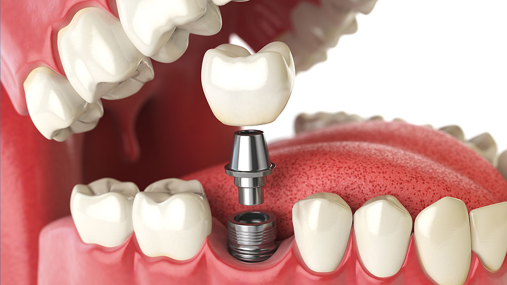 Types of dental implants