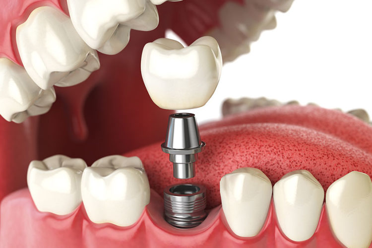 Types of dental implants