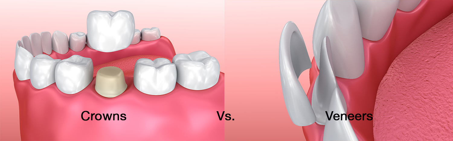 Veneers vs. Crowns