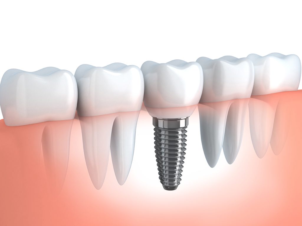 picture of dental implants