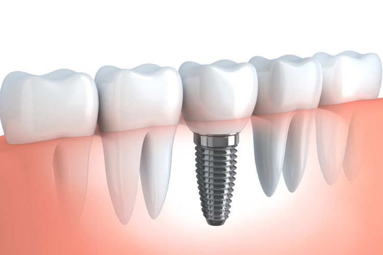 picture of dental implants