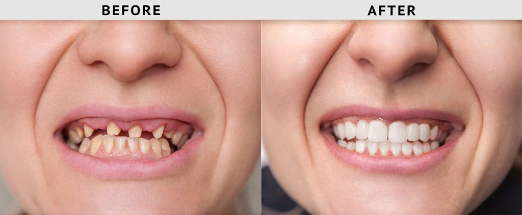 missing teeth before after treatment