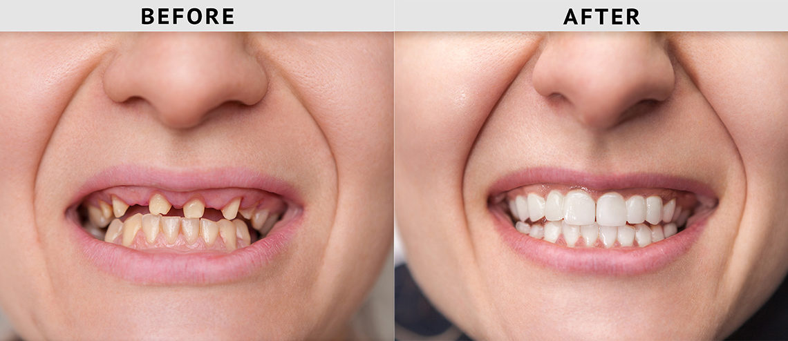 missing teeth before after treatment