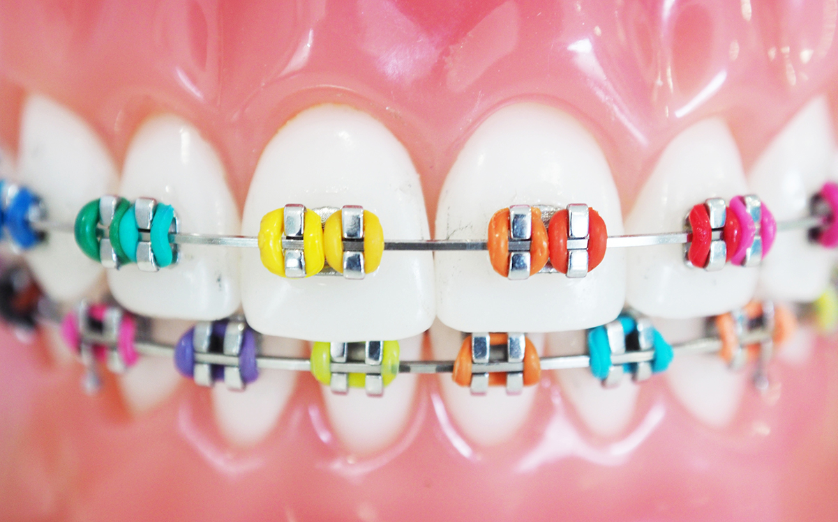 braces color wheel braces color