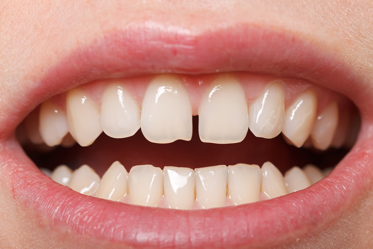 Teeth Bonding For Gaps, Teeth Gap Filling Cost