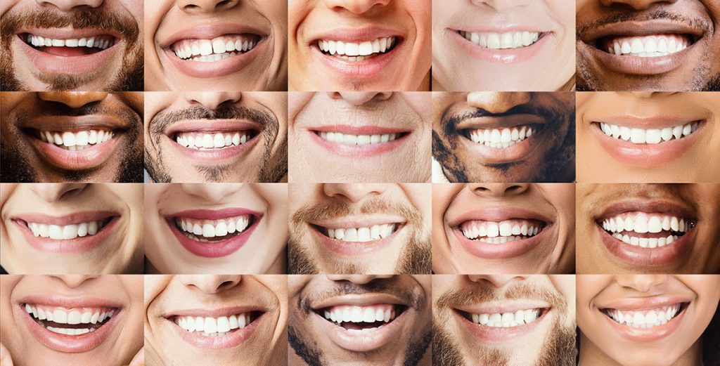 teeth whitening candidates