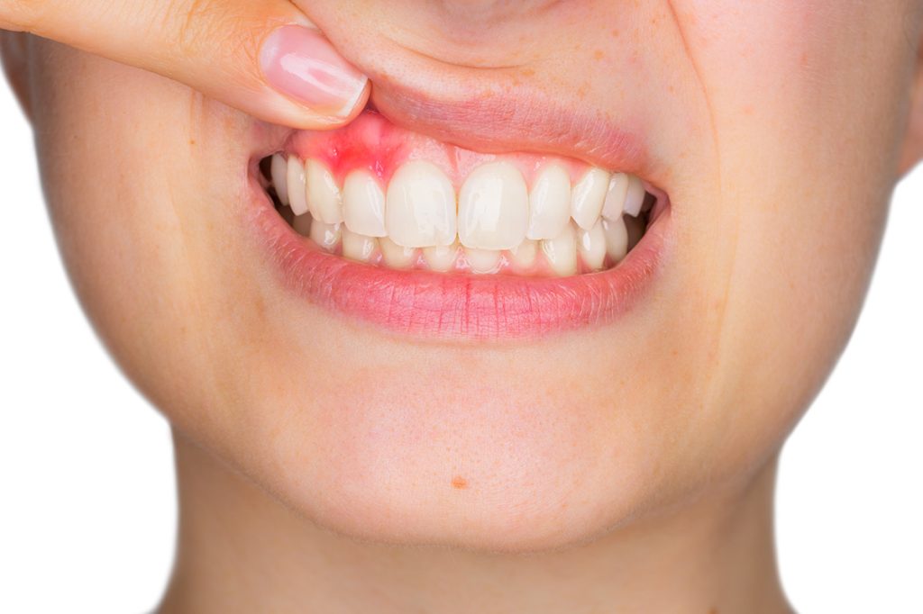 Understanding Gingivitis Treatment