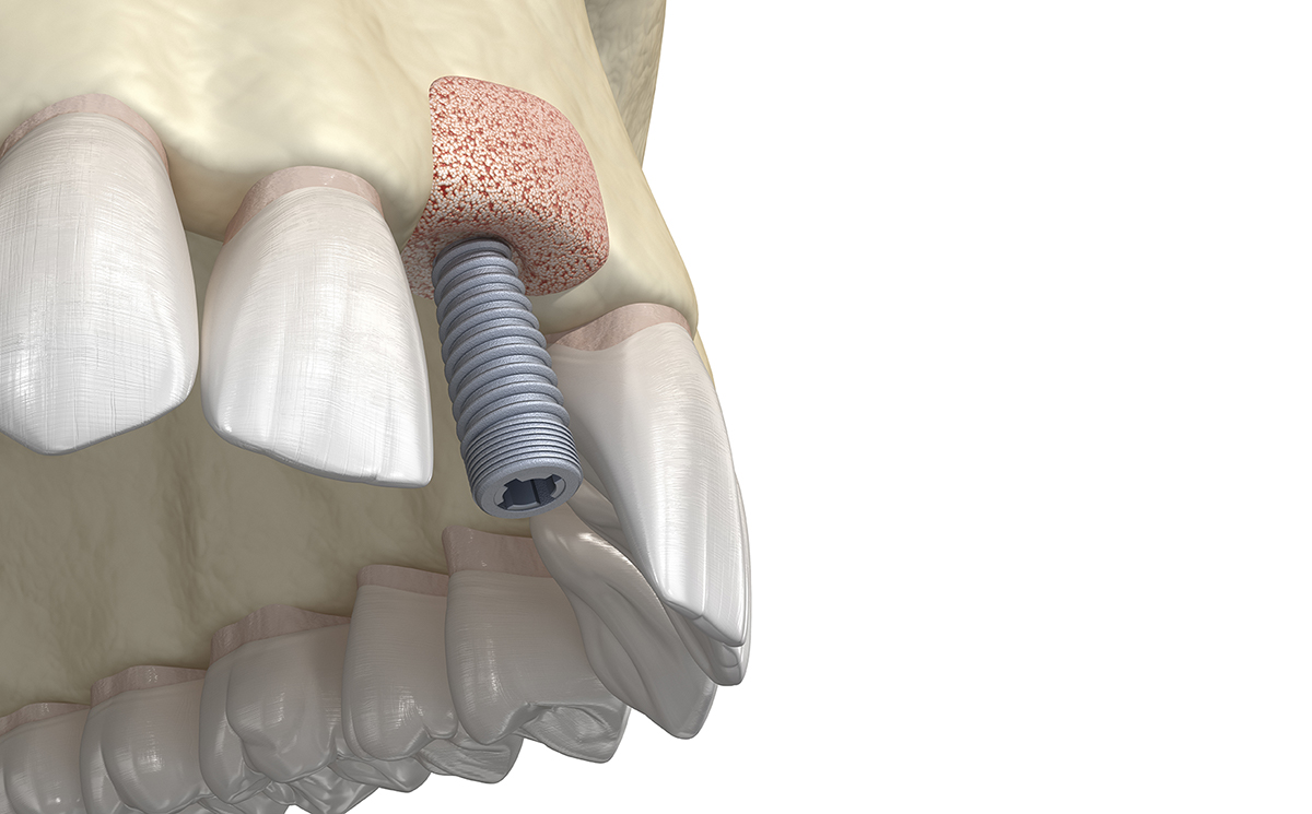Bone Grafting for Dental Implants
