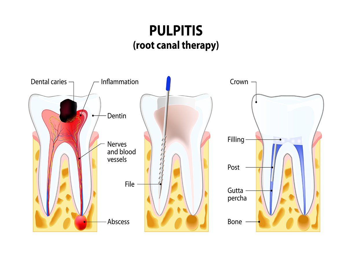 root canal therapy steps