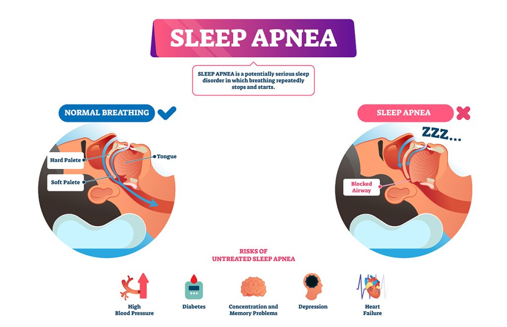 sleep apnea treatment