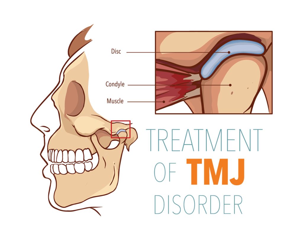 TMJ treatment Los Angeles