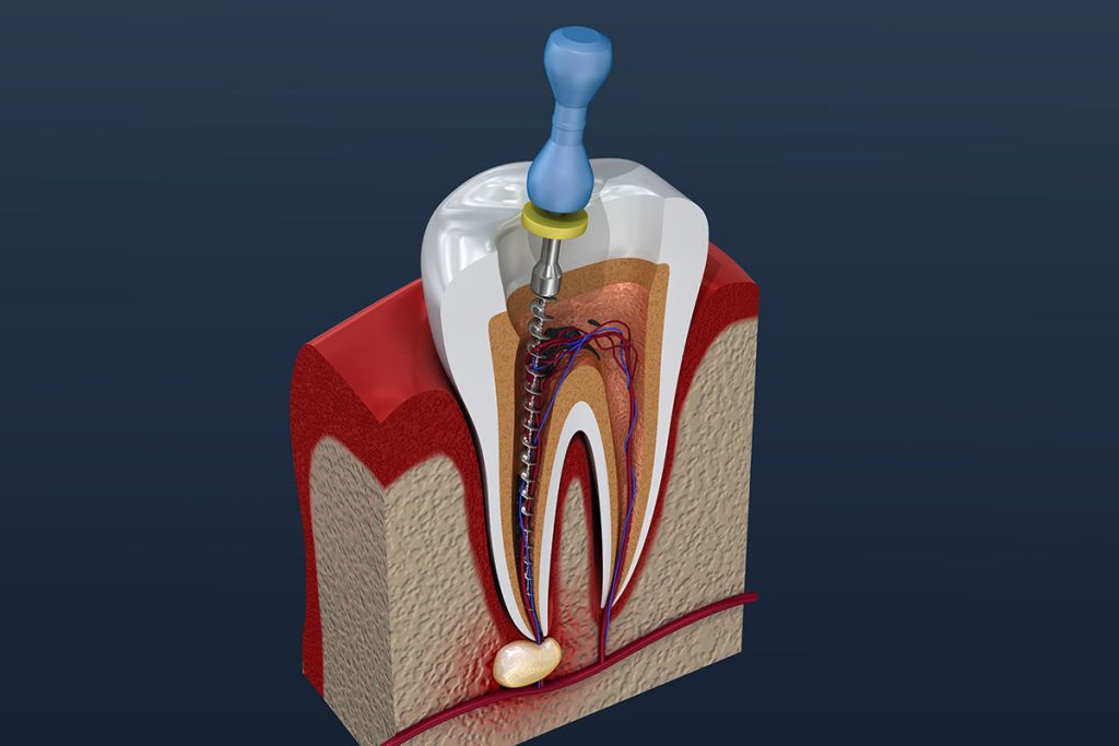 root canal treatment and crown