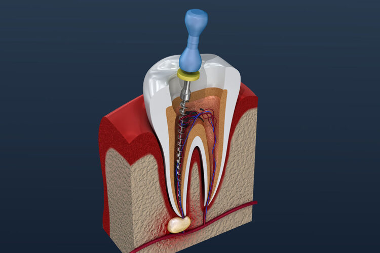 root canal treatment and crown