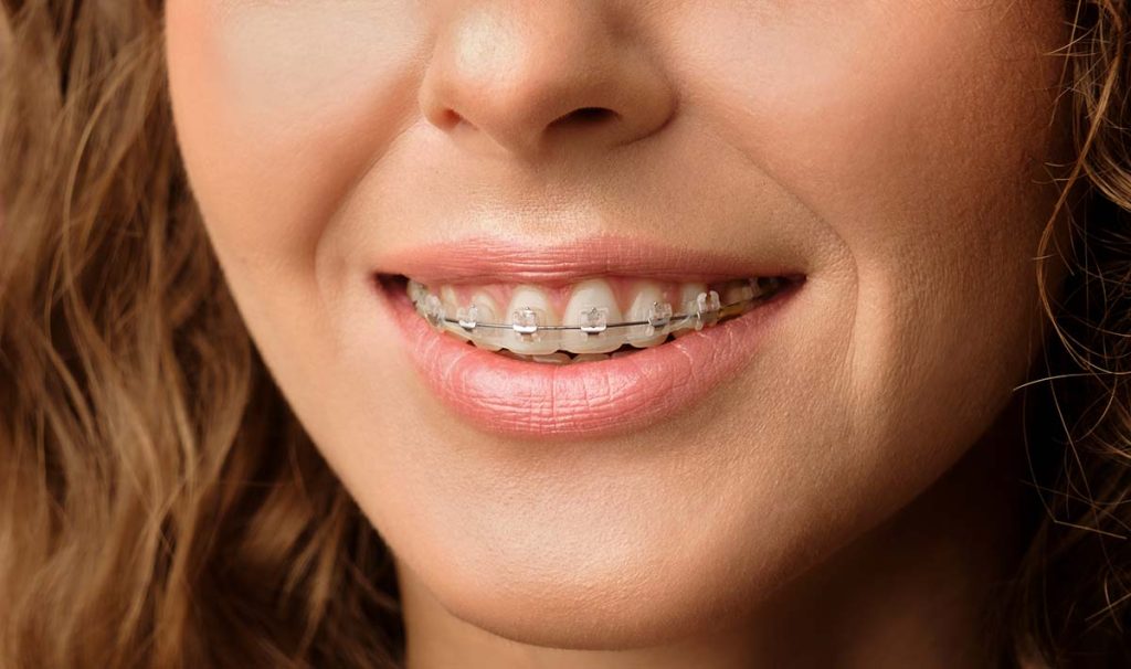dental braces cost with insurance