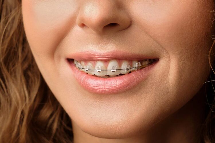 dental braces cost with insurance