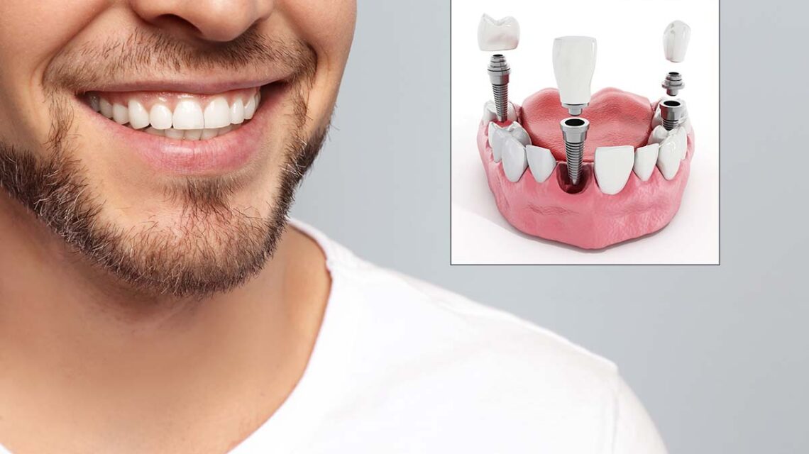 dental implants safe