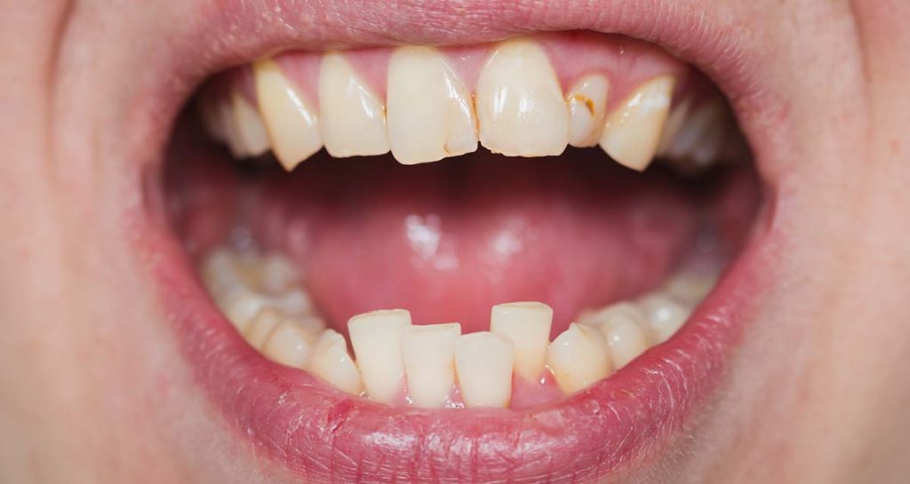 crooked teeth treatment beverly hills